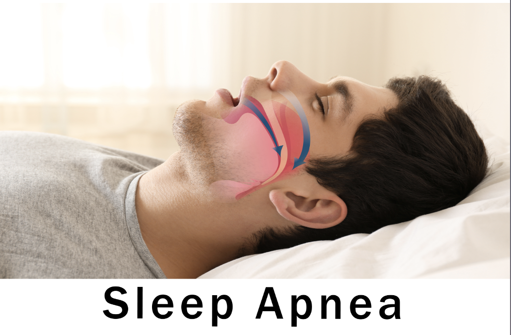 Sleep apnea images - sleep apnea treatment Sebastopol CA