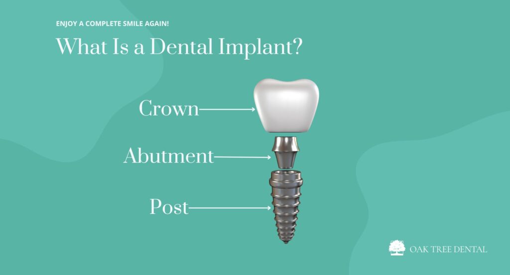 Diagram shows the 3-part structure of a dental implant similar to our custom dental implants in Sebastopol.